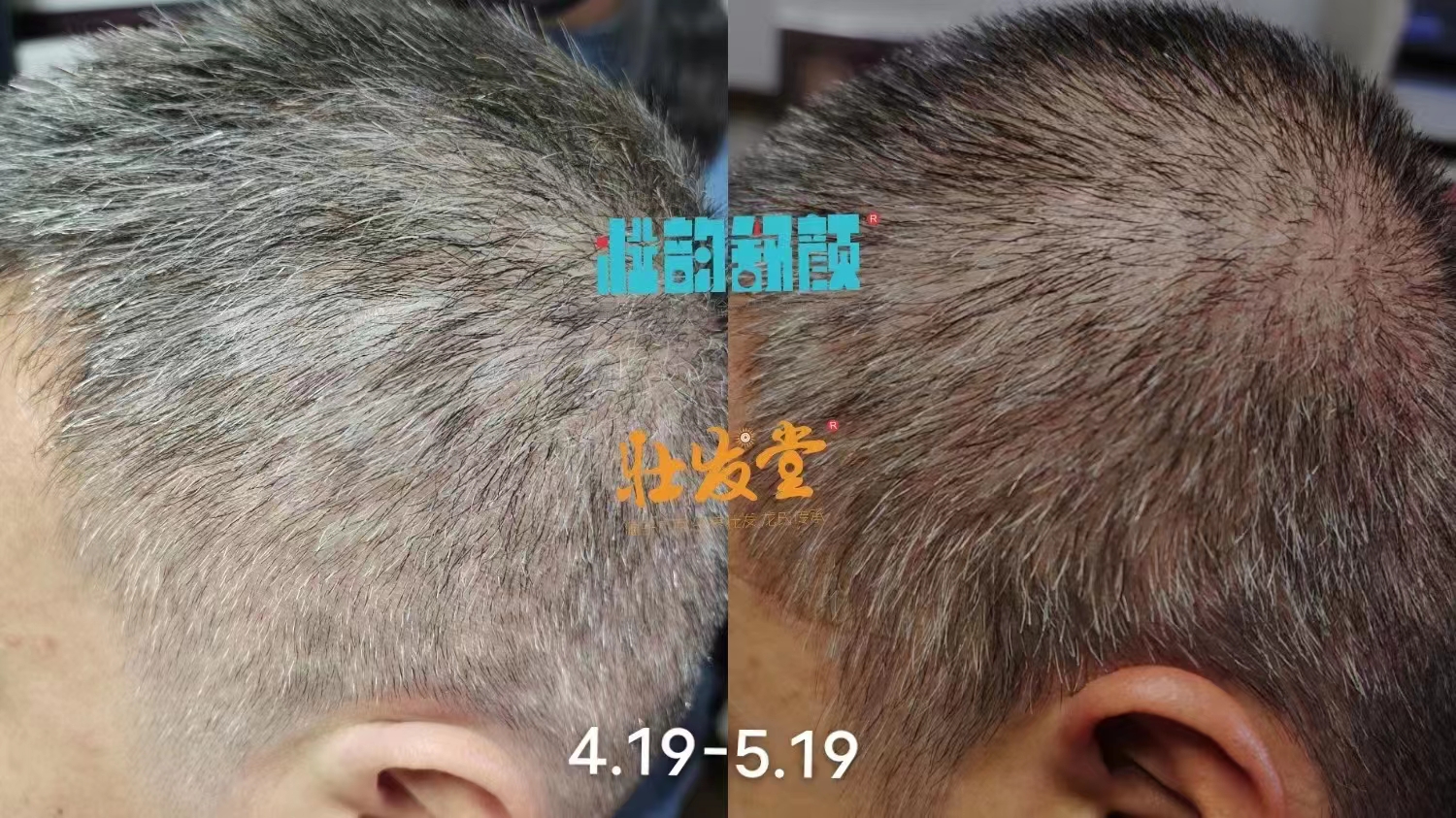 家族遗传白发使用壮发堂打卡一个月