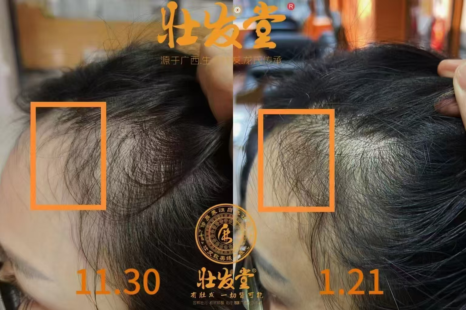 壮发堂帮你拯救发际线