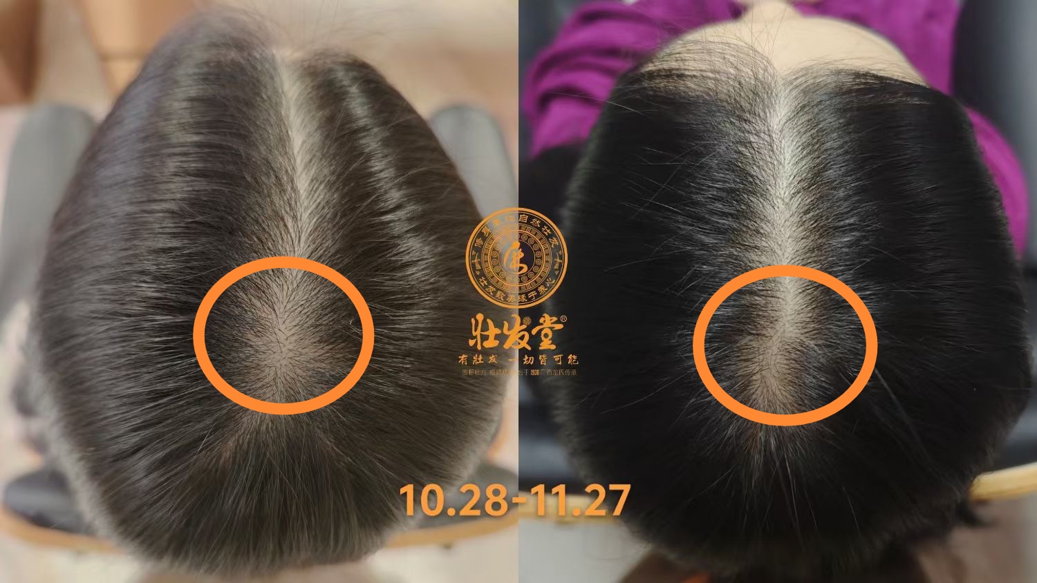 发缝宽别着急，壮发堂来帮你