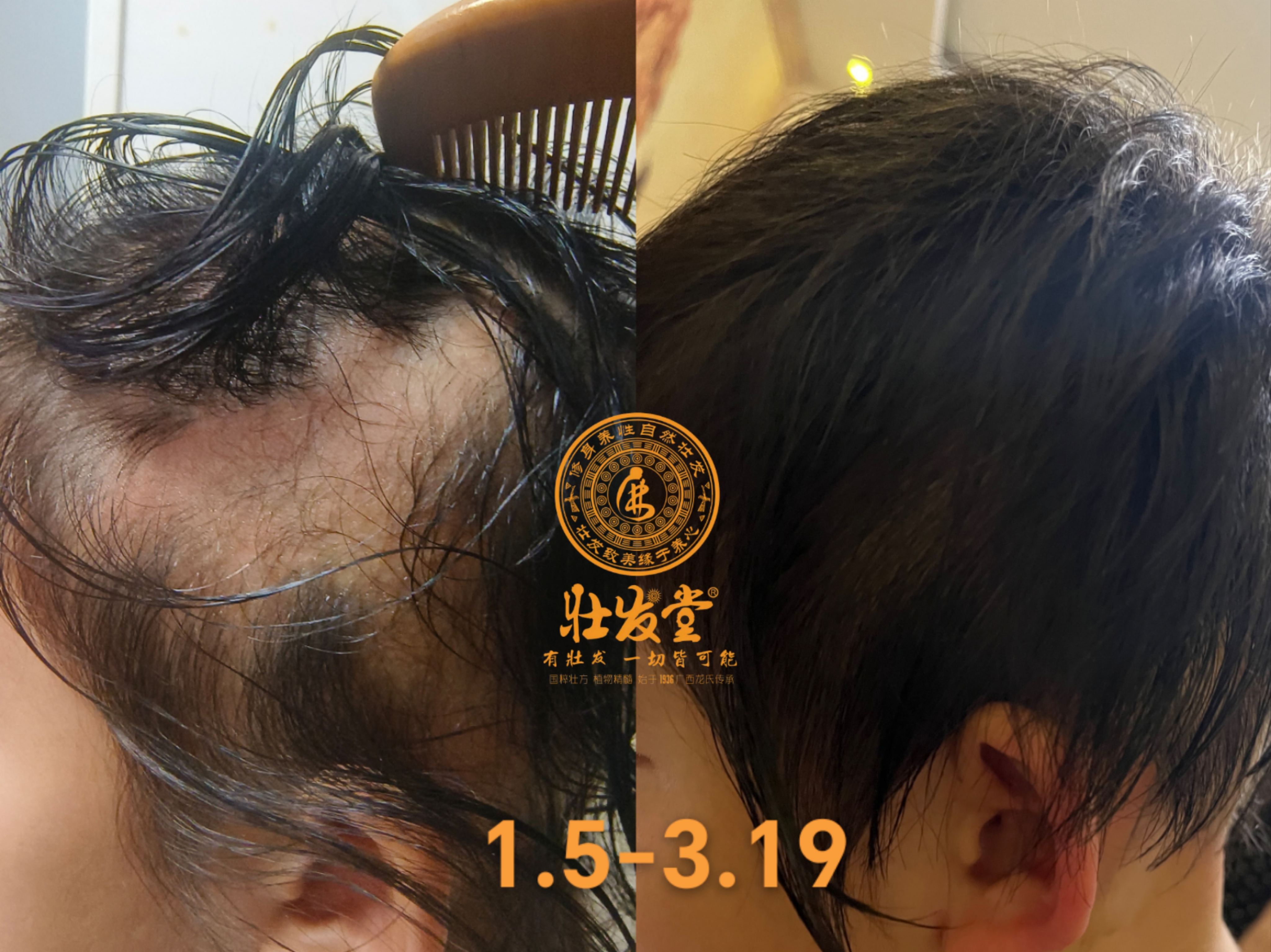 内蒙小女孩生发第73天