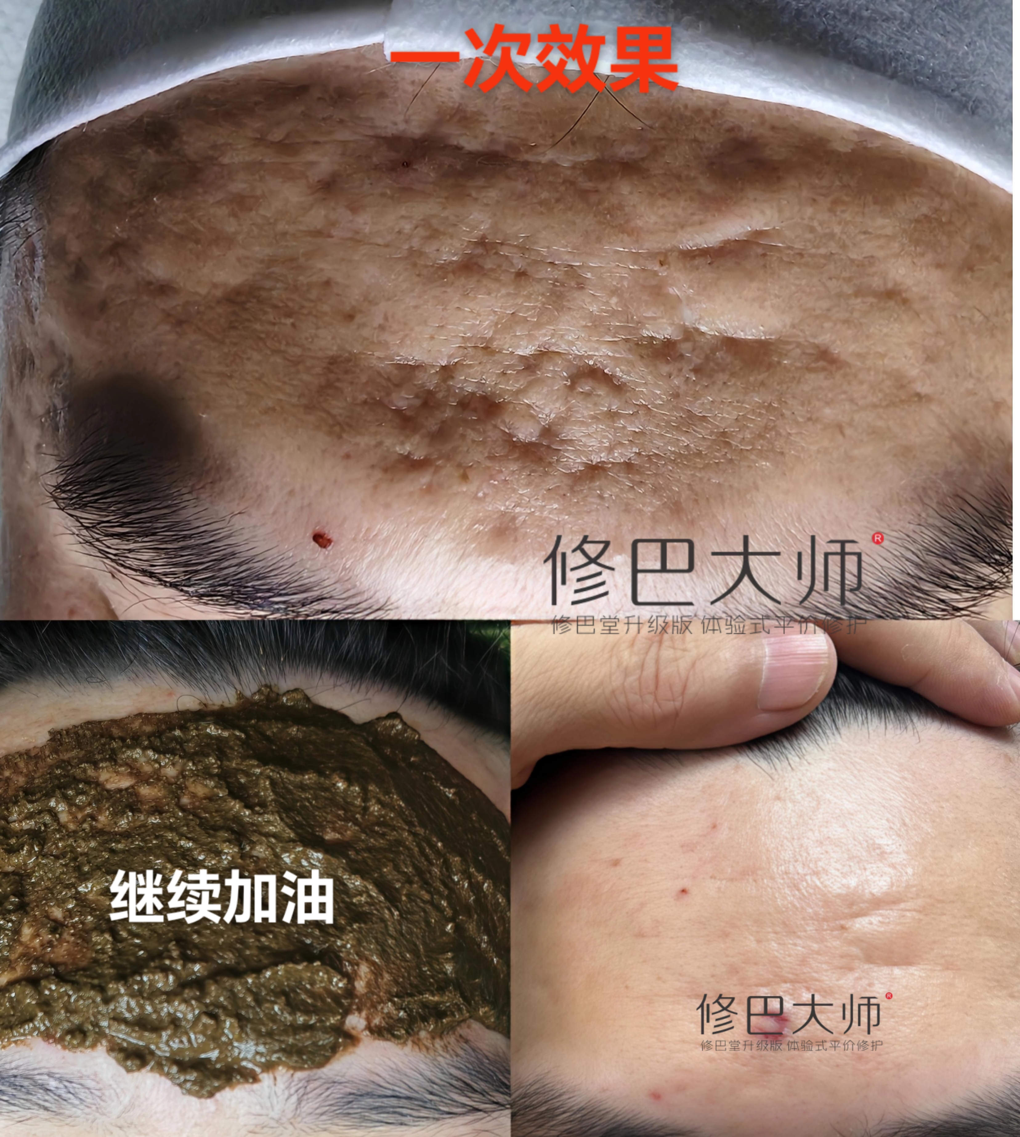 痘坑修复一次的效果