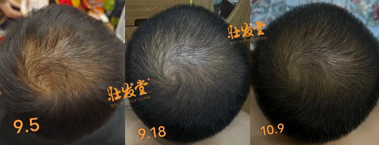 脱养密一个月左右的效果