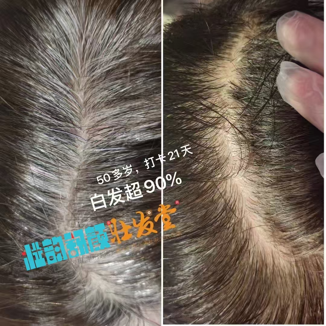 50多岁，白发转黑打卡21天