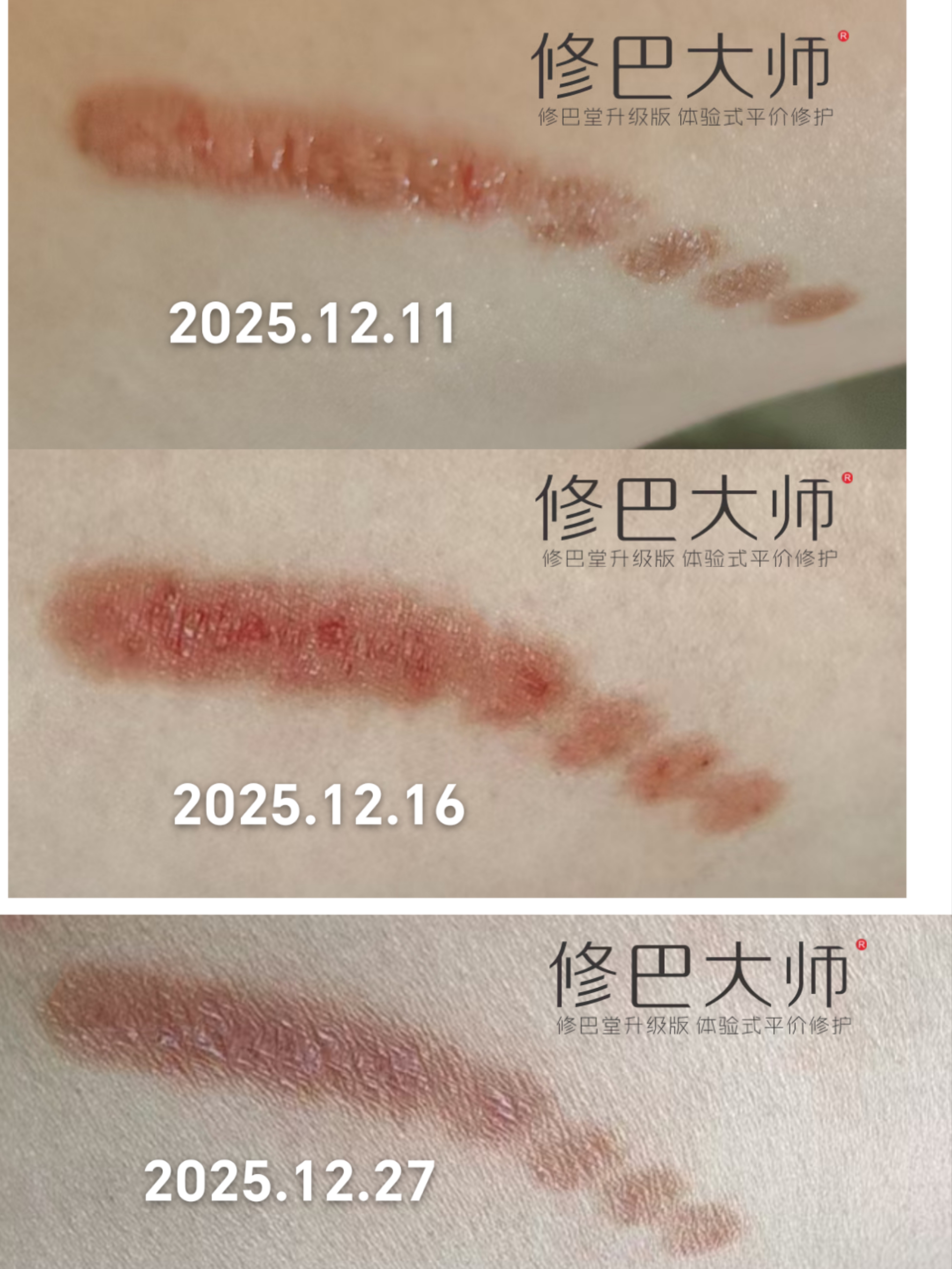 烫伤大腿，自己涂抹16天