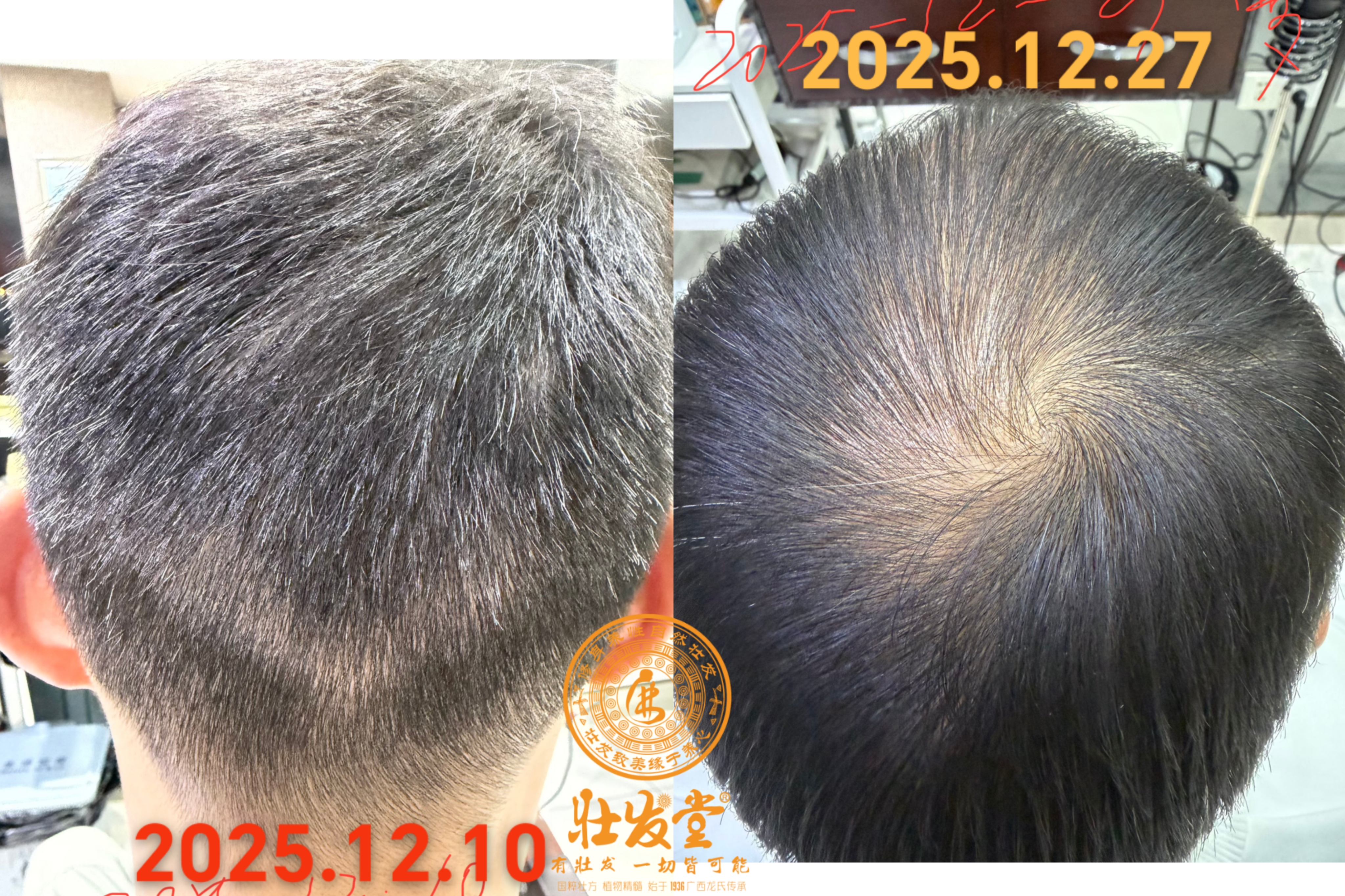 长沙壮发堂加盟店白养黑打卡