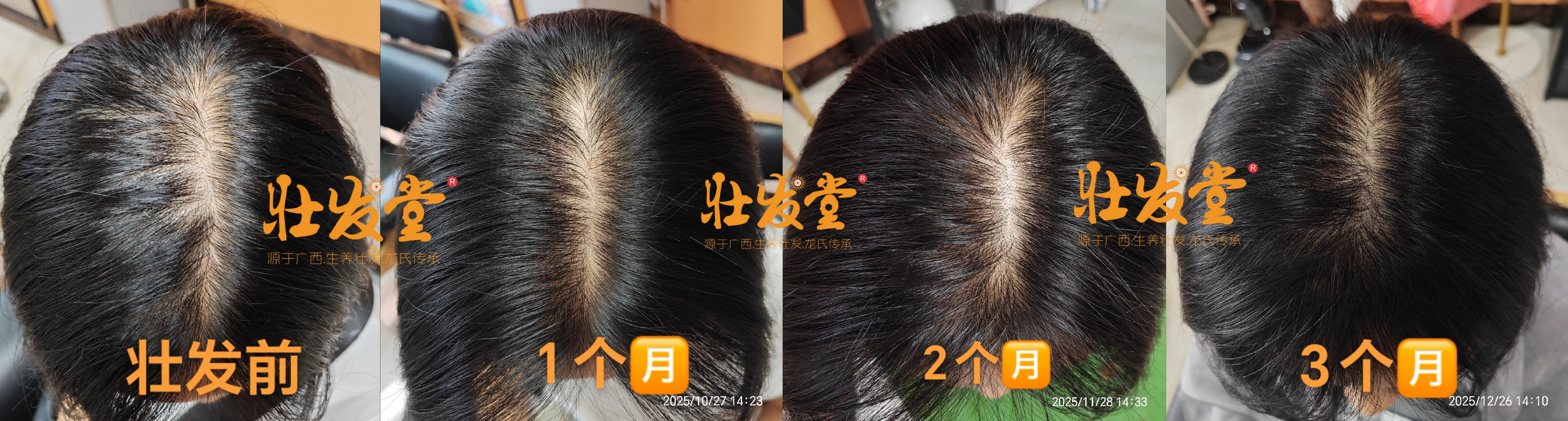 壮发堂生发发缝3个月变化