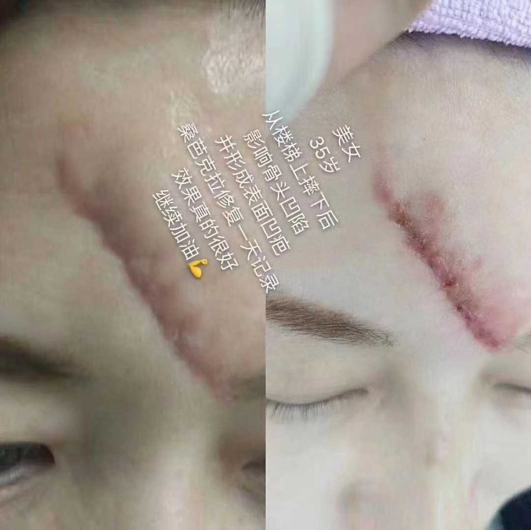 疤痕修复一天记录