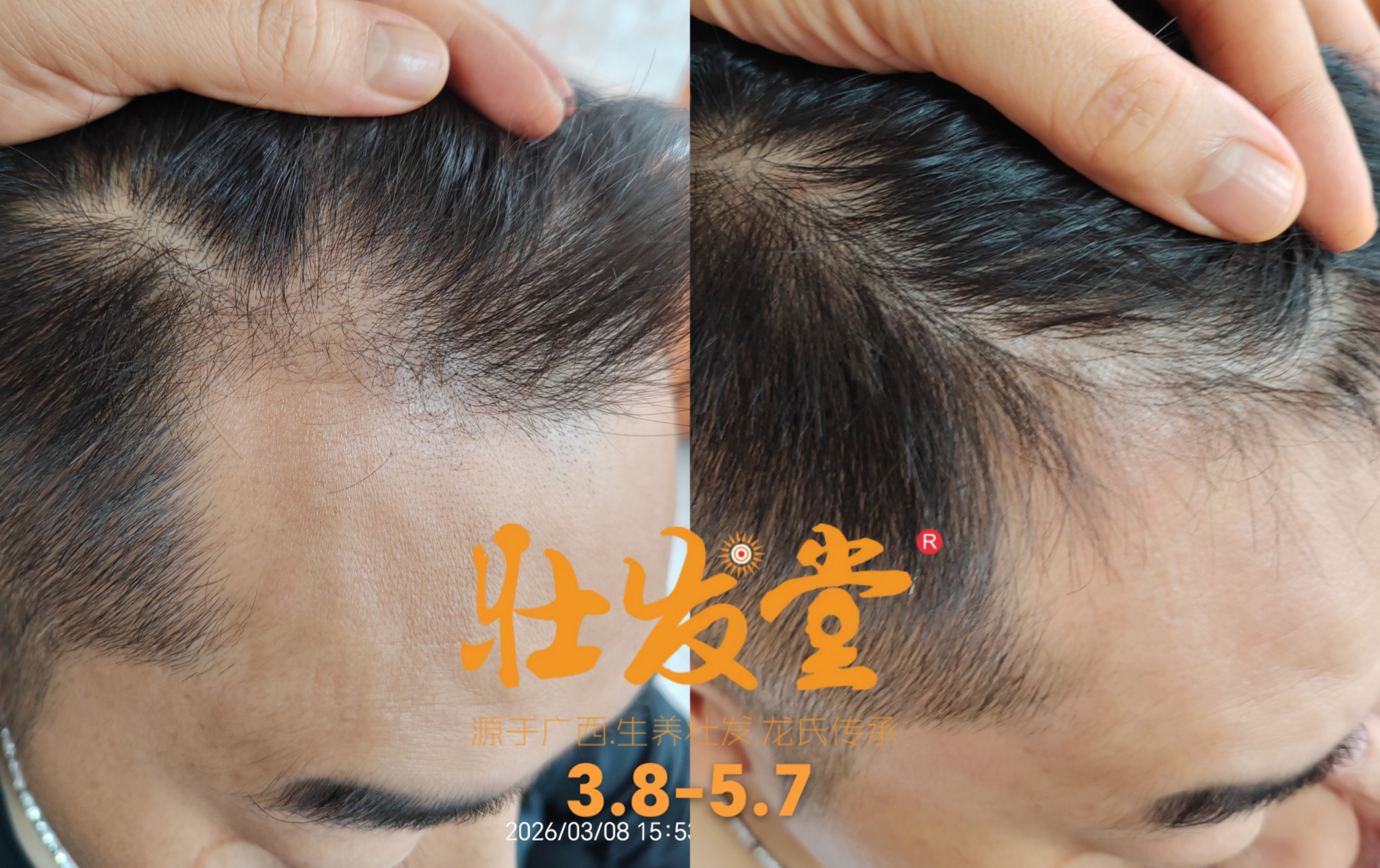 脱养密 两个月效果