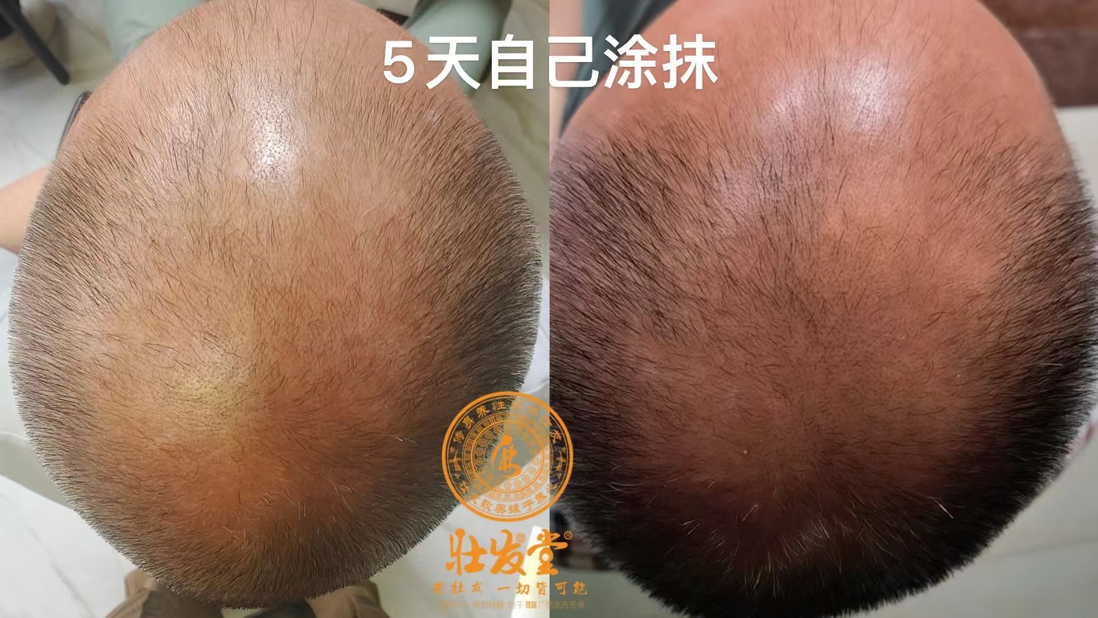5天自己涂抹